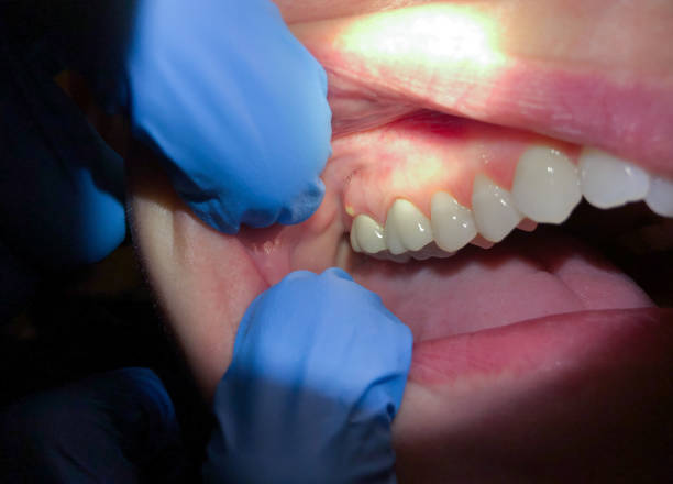 Best Emergency Care for Gum Disease in Hartford, AL